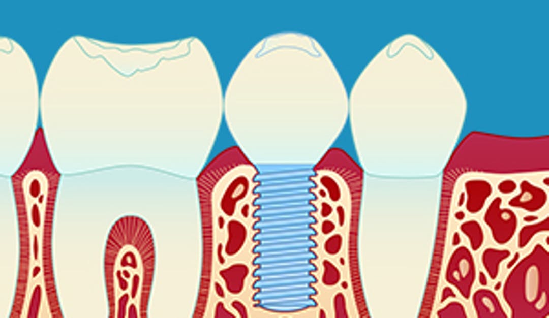 Implantater