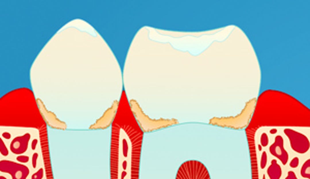 Gingivitt