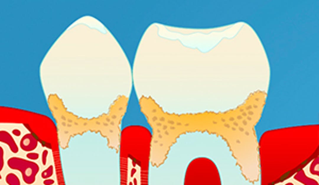 Periodontitt