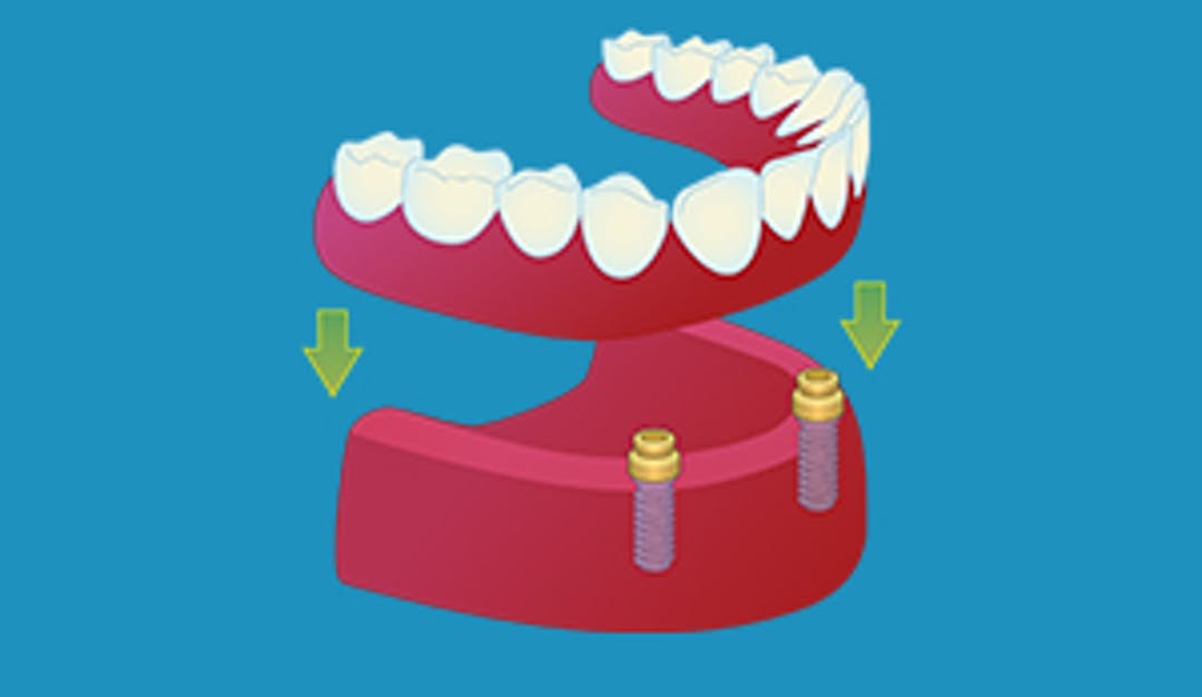 Implantatforankret helprotese
